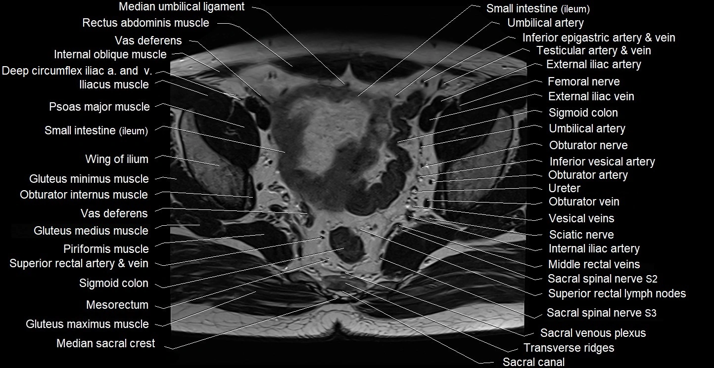 Male pelvis axial cross sectional anatomy image 17.webp
